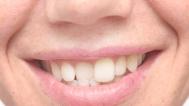 Beautiful:1wjzdxjldrc= Crooked Teeth
