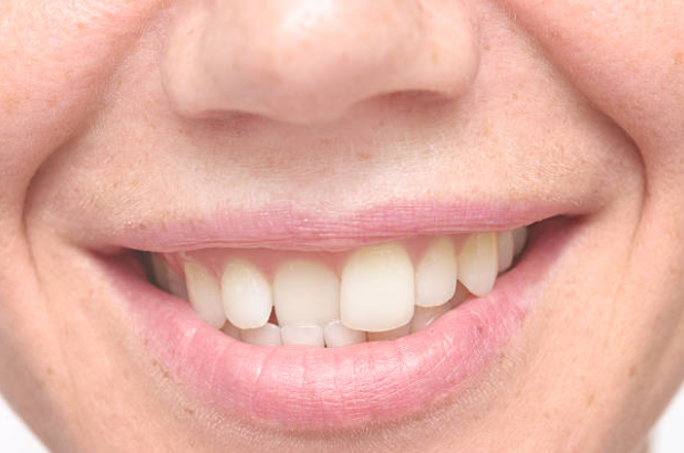Beautiful:1wjzdxjldrc= Crooked Teeth